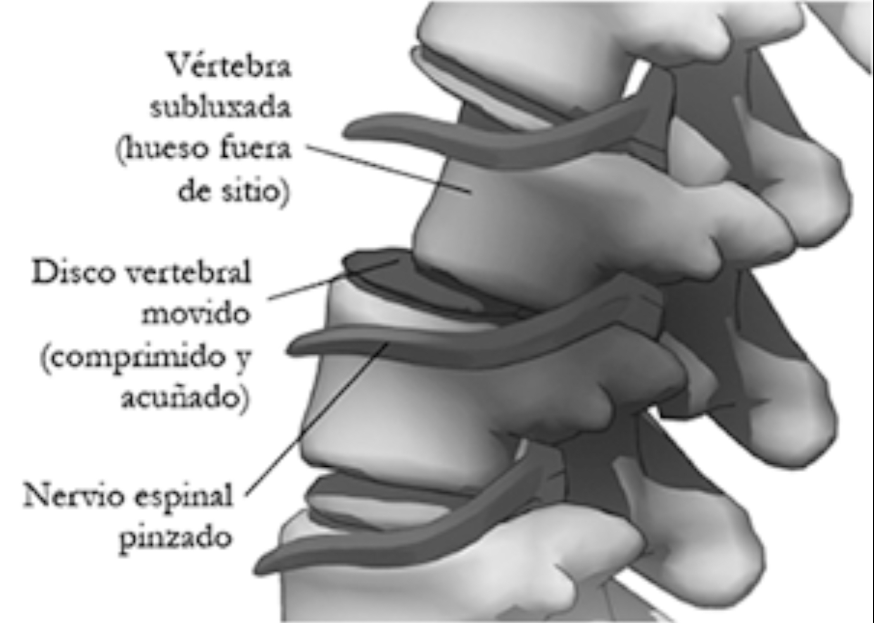 Esquema de una vértebra fuera de posición que comprime el disco vertebral y provoca pinzamiento del nervio espinal.